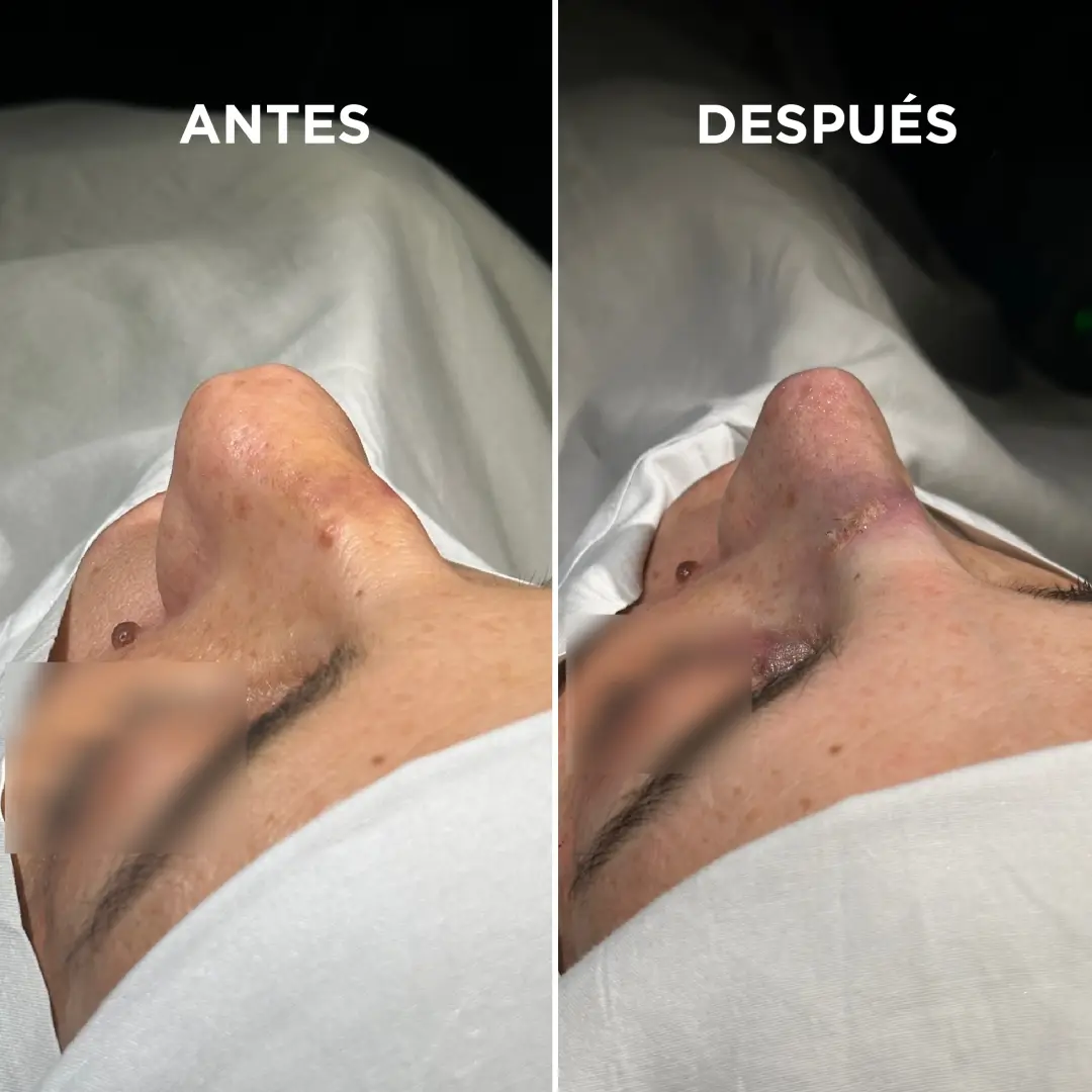 👨🏻‍⚕️✨ La clave de un buen resultado no está solo en la técnica, sino en elegir un profesional de confianza. Cada rostro es único y merece un análisis detallado de sus rasgos para lograr armonía, equilibrio y naturalidad. 🔹 Un especialista con experiencia sabe qué cambios potencian tu belleza sin perder tu esencia. 🔹 La planificación adecuada asegura resultados seguros y profesionales. 👉🏼 Recordá: no se trata de cambiar quién sos, sino de realzar lo mejor de vos con el conocimiento y la mirada de un experto.