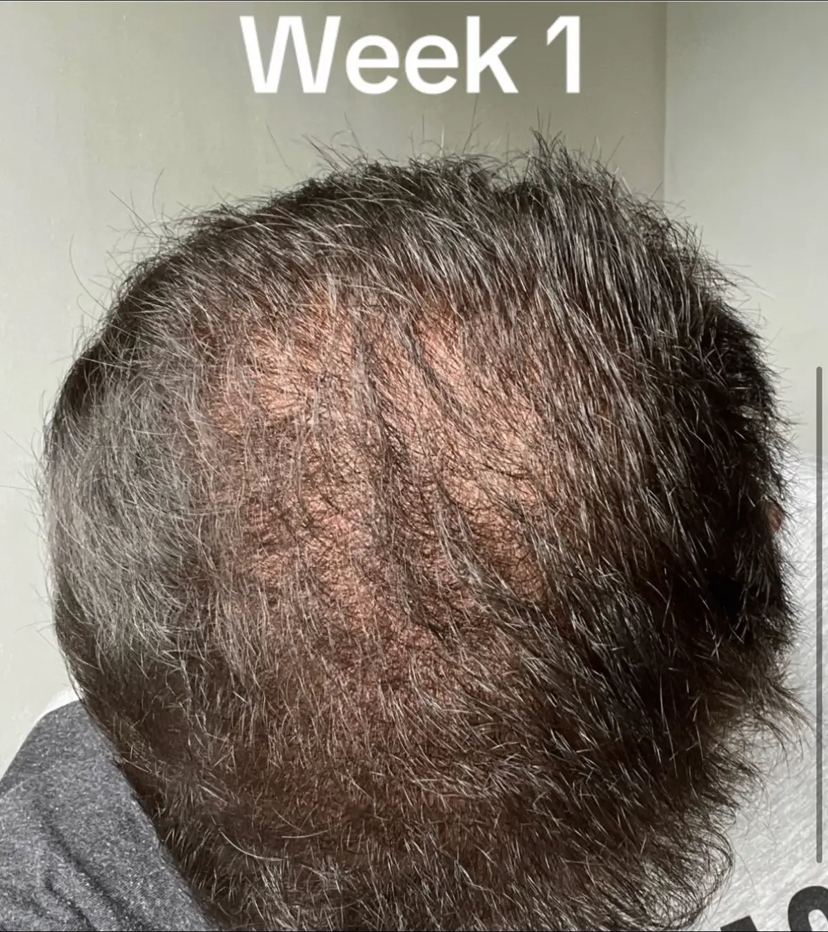 Hair Transformation including shedding phase #hairloss #transformation #hairgrowth #fyp