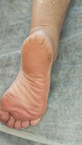 2° sessão da Plástica dos pés 👣👣 