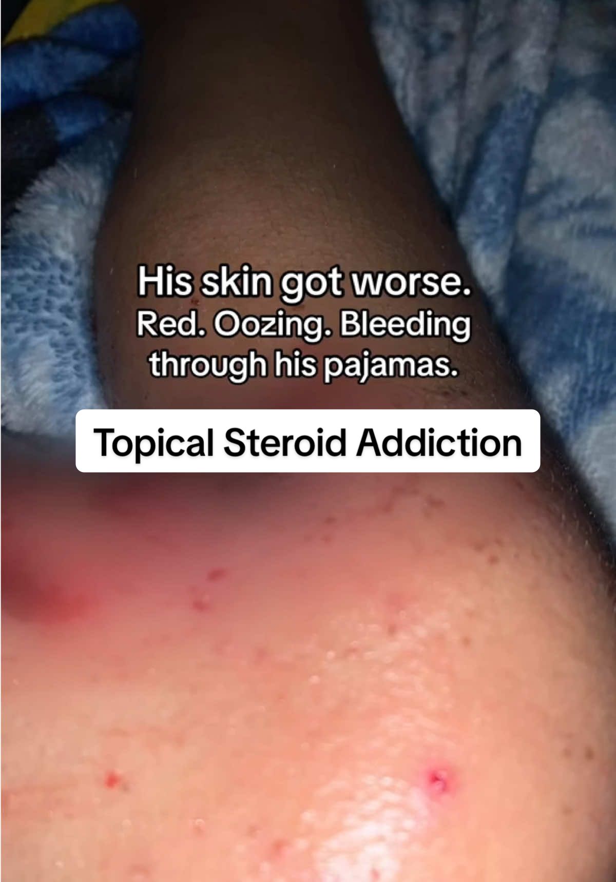 This was preventable. It was one of the hardest seasons we've lived through. Watching him scratch until he bled, cry in the bath, lose sleep night after night. And feeling like I was failing him. But his suffering wasn't in vain. Because it led me here. To learning, to healing, to creating something with purpose. And now... I get to help other moms find a way out too. #topicalsteroidaddiction #eczema #eczemaawareness