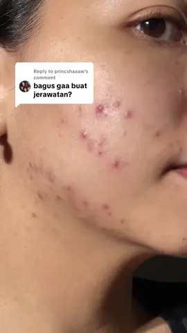 Replying to @princshaaaw emang for acne skin ini ceritanya 🙂‍↕️  #AcneBestie #Acnaway #SafeforAcneSkin #Sunscreenacnaway @Acnaway Official 