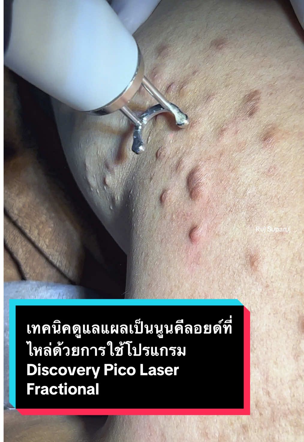 เทคนิคดูแลแผลเป็นนูนคีลอยด์ที่ไหล่ด้วยการใช้โปรแกรม Discovery Pico Laser Fractional Mode for Keloid Treatment  โปรแกรม #discovery โปรแกรม #picolaser  โปรแกรม #picosecondlaser  #แผลคีลอยด์ #รักษาแผลเป็น #รักษาแผลเป็นคีลอยด์  @Ruj Suparuj 