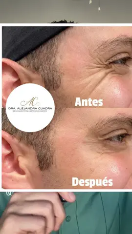 ME ANIMÉ Y LO AMÉ 😂🤩  #tijuana #sandiego #bajacalifornia #botox #estetik 