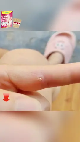 Say Goodbye to Pain, Reclaim Your Confidence!  Troubled by painful corns? Our corn patches provide quick relief, soften corns, and offer all-day comfort. Walk with ease and comfort every step!  Product Features:  Deep relief, pain alleviation  All-day protection, no pressure  Gentle formula, suitable for all skin types  For: People who stand for long hours or wear ill-fitting shoes.  Reclaim your comfort now! Buy now and enjoy exclusive discounts!  #CornPatch #ComfortableSteps #FootCare #PainRelief