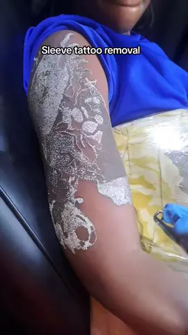#onthisday #lasertattooremoval #tattooremoval #tattooremovalspecialists #tattooremovalbeforeandafter 