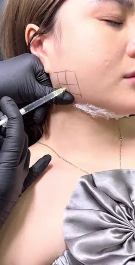 Thon gọn hàm cho khách bên em #nhận_tiêm_filler_tại_nhà #tiêm_filler_botox💉 #xuhuongtiktok #xuhuong 