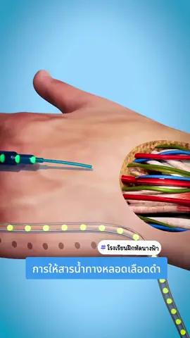 🩺💉 ให้น้ำเกลือแล้วเส้นเลือดอักเสบ? (Phlebitis) มาดูวิธีป้องกัน! 🩹   Phlebitis คืออะไร? 😫 เส้นเลือดดำอักเสบจากการให้น้ำเกลือนั่นเอง!   อาการมีอะไรบ้าง? 🤔   - ปวด บวม แดง ร้อน 🔥 - คลำเจอเส้นแข็งๆ 🧱   ทำไมถึงเกิด? 🤷‍♀️   - สายใหญ่ไป 📏 - สารน้ำระคายเคือง 🧪 - คาทิ้งไว้นาน ⏰   วิธีป้องกันง่ายๆ! ✨   - เลือกสายให้เหมาะกับเส้น 🤏 - ทำความสะอาดก่อนแทง 🧼 - เปลี่ยนสายตามเวลา 🗓️ - Saline lock ช่วยได้! 🔒   เป็นแล้วทำไง? 🚨   - หยุดน้ำเกลือ ❌ - ประคบอุ่น 👍 - ยกแขนสูง ⬆️ - ปรึกษาหมอ 👨‍⚕️ #Phlebitis   #พยาบาล #โรงเรียนฝึกหัดนางฟ้า 