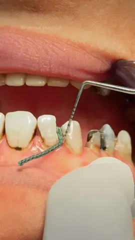 Composite restoration after root canal treatment of upper anterior lateral tooth 🦷 #dentist #UK 