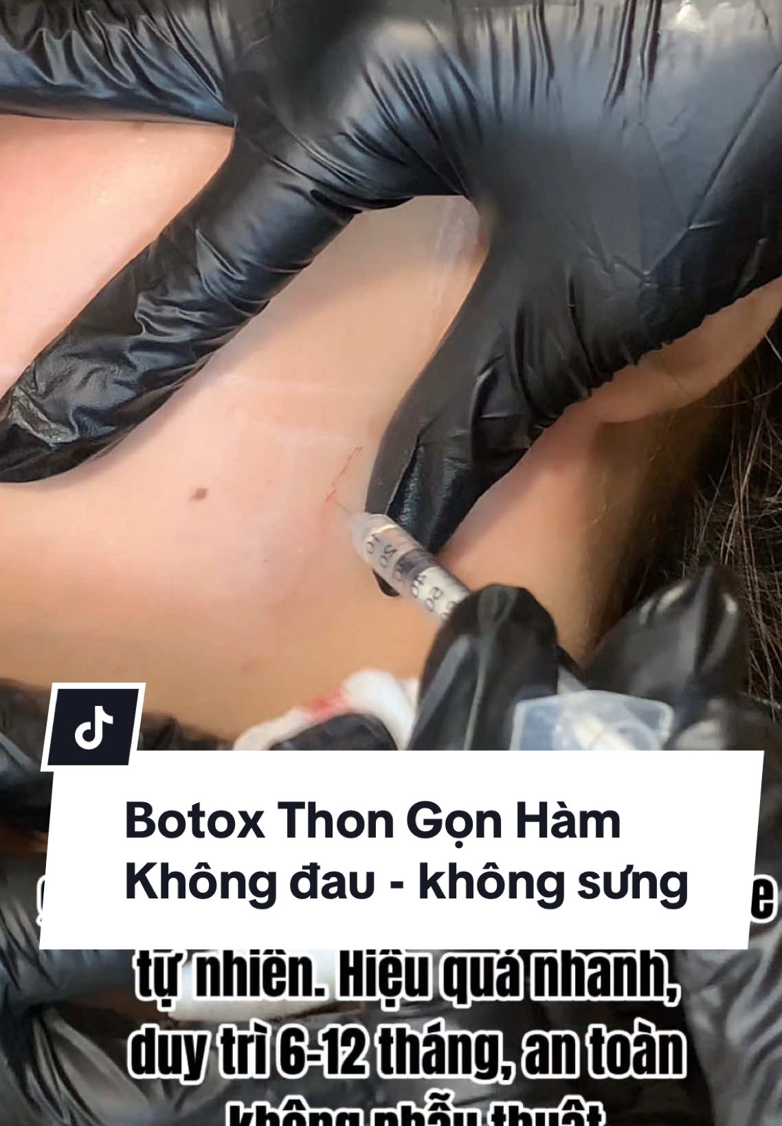 “Cơ hàm to làm mặt vuông thô? Botox chỉ 1 lần – gọn ngay sau 5 ngày!”#xuhướng #ArisAcademy 