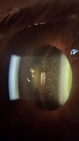 What are these cells circulating in the anterior chamber?  #ophthalmology #optometrist #oftalmologia #medicine #офтальмолог