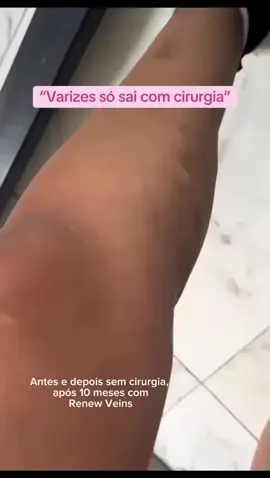 tenha mais qualidade de vida, pernas mais leves e lindas!!! #varizes #varizessemcirurgia #varizesnuncamais #varizesevasinhos #mulheres 