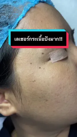 เลเซอร์กระเนื้อ ปังมาก!! #เลเซอร์co2 #เลเซอร์กระเนื้อ #เลเซอร์ติ่งเนื้อ #เลเซอร์ขี้แมงวัน #จี้ไฝ 