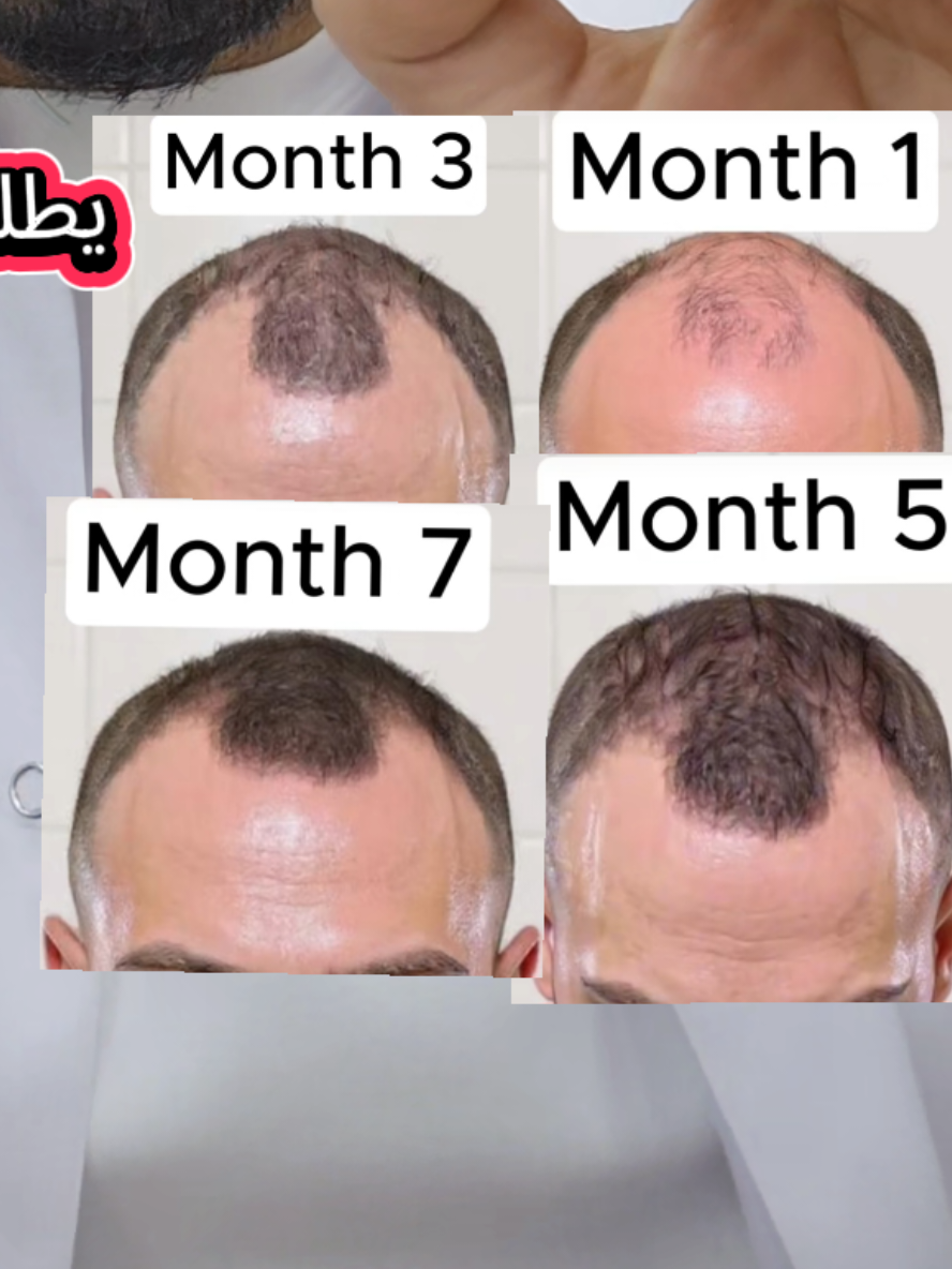قاهري الصلع بيصورو نتائج المينوكسيديل اسبوعيآ  #صلع #مينوكسديل #قاهري_الصلع_الوراثي #eslamelghopary 