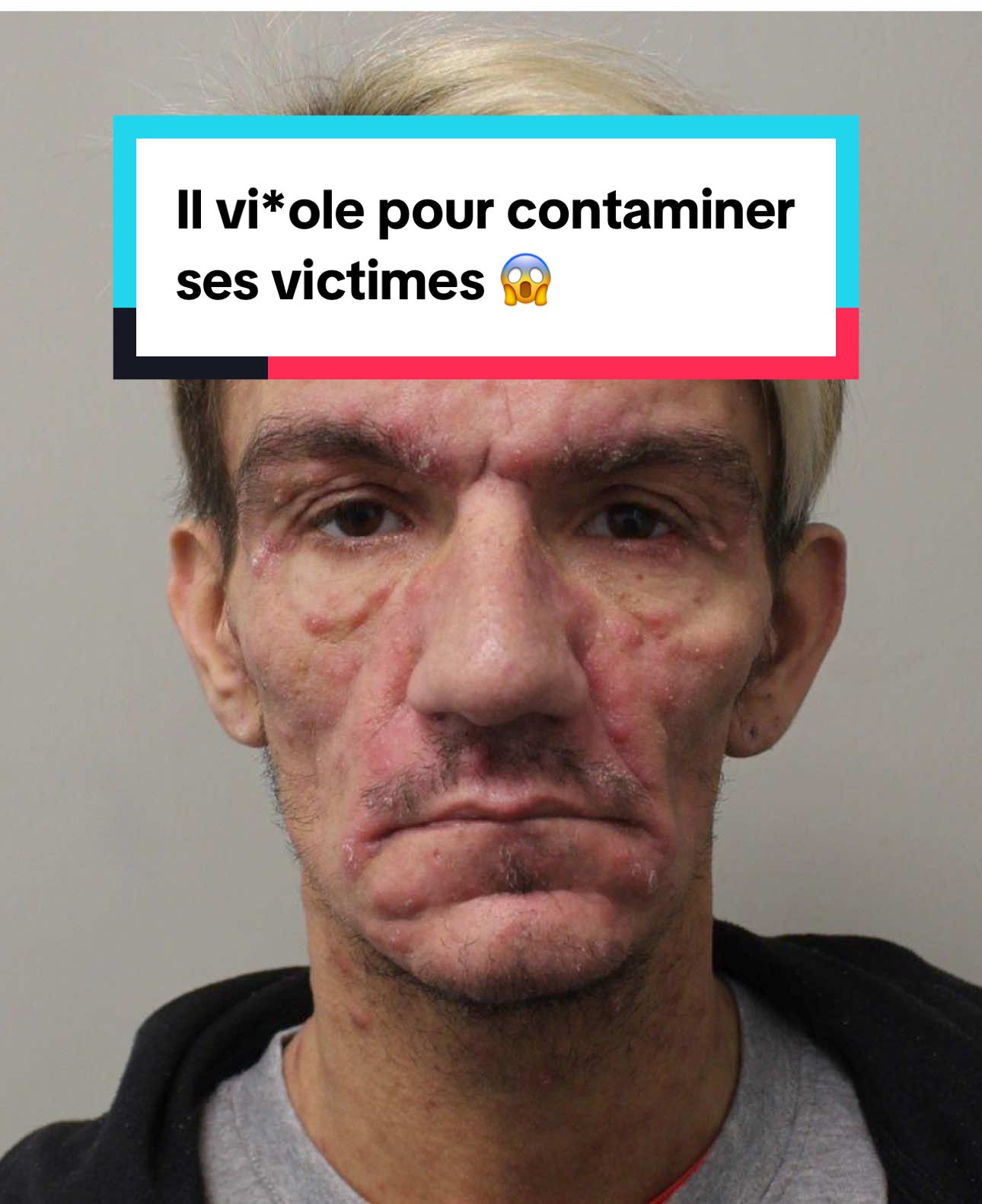 ‼️ Un prédateur à Londres aurait contaminé des centaines d’hommes au VIH. Déjà 82 victimes identifiées… mais la police cherche encore plus de 300 personnes, potentiellement atteintes du SIDA.  Une affaire glaçante qui choque le Royaume-Uni. 👉 Penses-tu que 17 ans de prison suffisent pour un tel acte ? #actualité #virus #londres #sida #justice