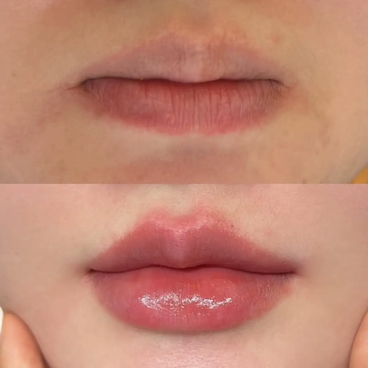 👉 Tình trạng môi gốc:nhăn, khoé cụp ẩn khoé, chưa rõ form dáng #tiemmoidep #tiemmoi #moibaby #CapCut #fillerbotox 