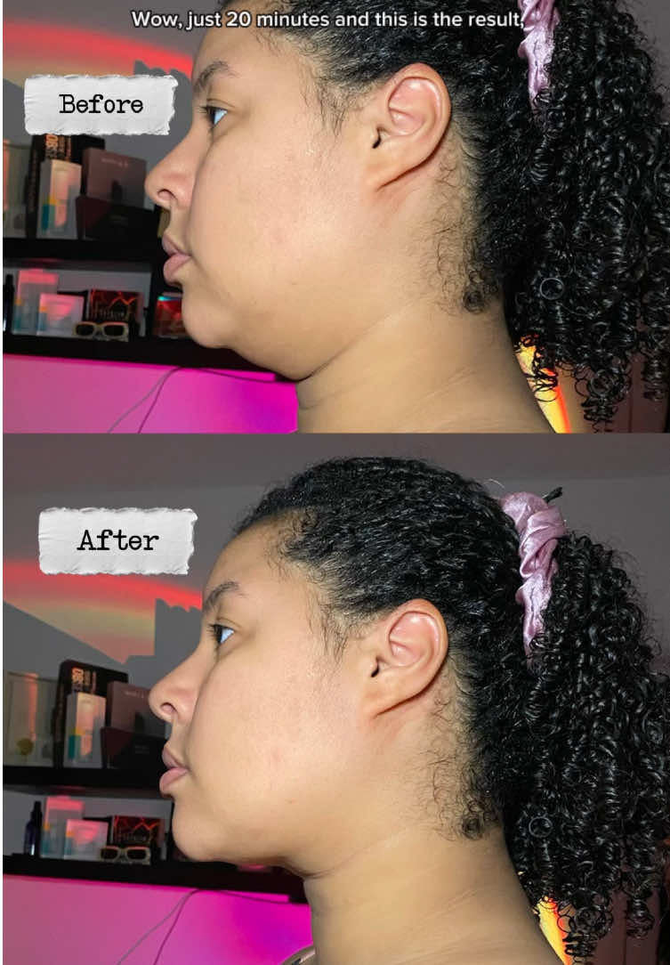 Before → After 💫 With no surgery 😮 Snatched jawline in just 20 minutes with the power of NAD+! This mask not only lifts but also boosts collagen, smooths, hydrates, and leaves your skin glowing ✨ 👉 Have you tried NAD+ skincare yet? Because once you do, there’s no going back. @numbuzin Global Marketing #numbuzin #nadliftmask #NAD #liftingmask #kbeauty