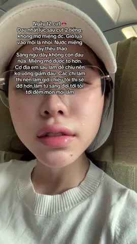Các chị làm rồi nói cỡ 6th sẽ về môi cũ còn hở lợi làm em hoang mang thật 😅🥺