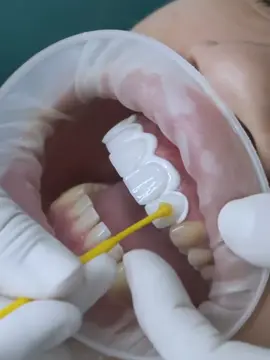 Dán sứ không mài răng #xuhuong #tiktokviral #thinhhanh #lava #trending 