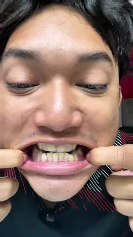 BARULA CONFIDENT NK SENYUM AMIK GMBR😍‼️‼️#fypaffiliate #whiteningstrips #gigiputih #whiteteeth #LifeHack 