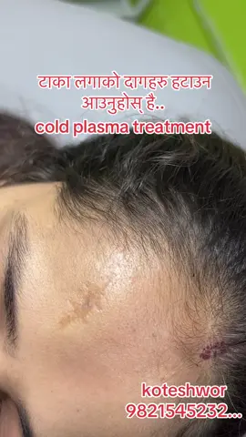 #scar #removal #daag #wrinkles #goviral 