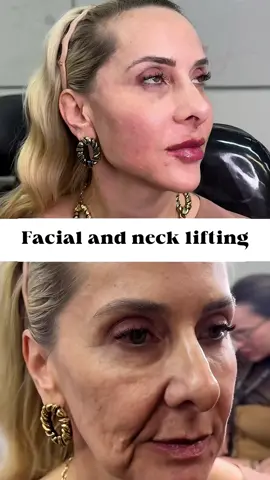 47 year old confident newcomer: A 47 year old woman who had sagging cheeks and sunken nasolabial folds before surgery and dared not take photos. She underwent a full-thickness SMAS fascia lift facelift surgery. One month after the surgery, the contour of the cheeks became clear, the jawline became sharp, and the nasolabial folds became noticeably lighter. Three months later, acquaintances were surprised by her changes when they met, and even their daughter joked that she was 
