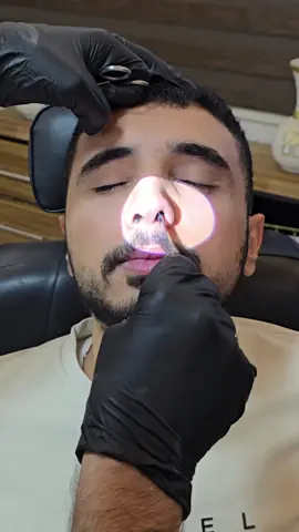 ازالة دعامات الوتيره الانفيه بعد تصحيح انحراف الوتيره الانفيه و قص وكي اللحميات [ القرنيات ] الانفيه