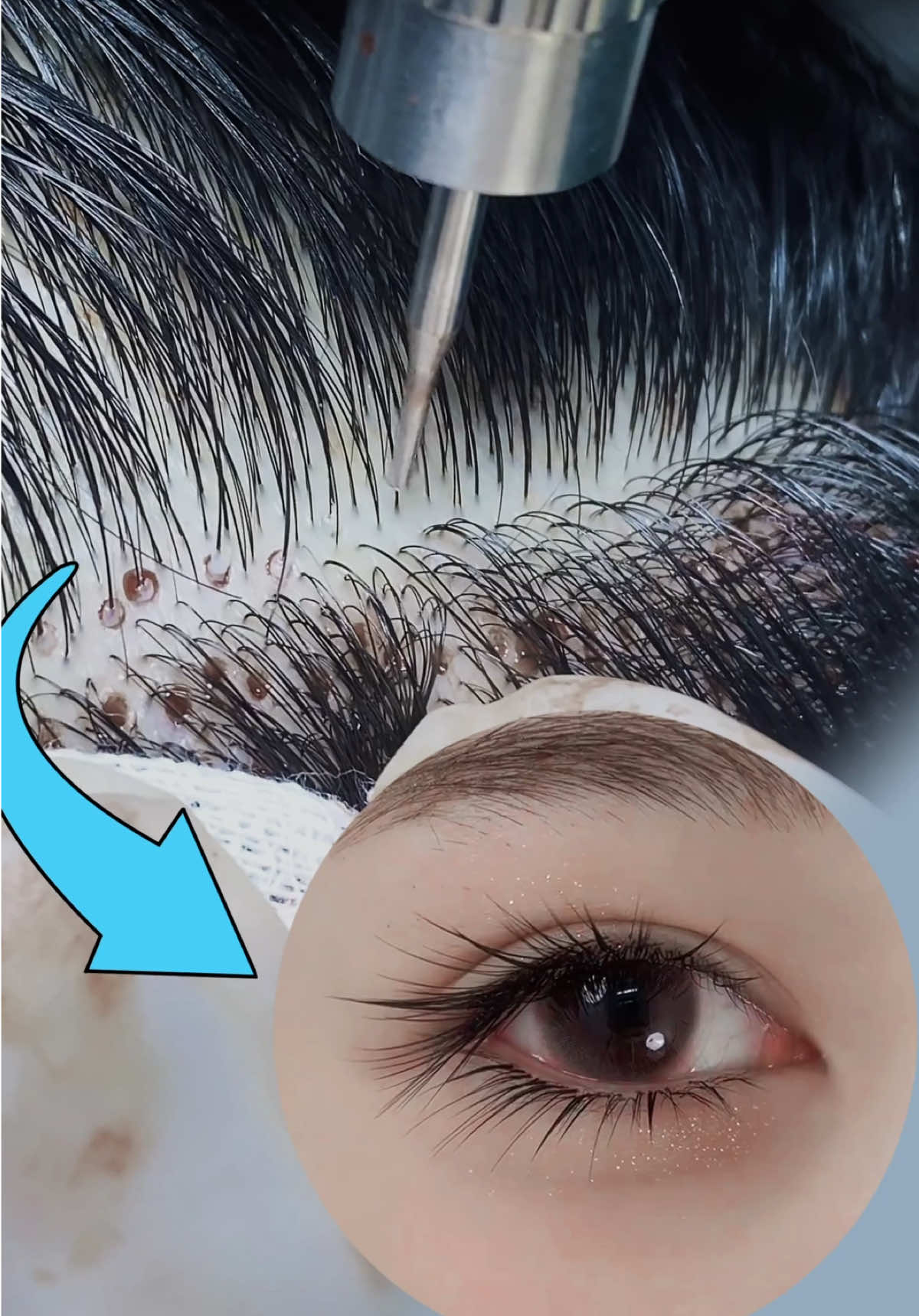 Eyebrows transplant and eyelashes transplant🥰🥰🥰#eyebrowtransplantation #eyebrowtrimming #beauty #植眉 #眉毛种植                     	  