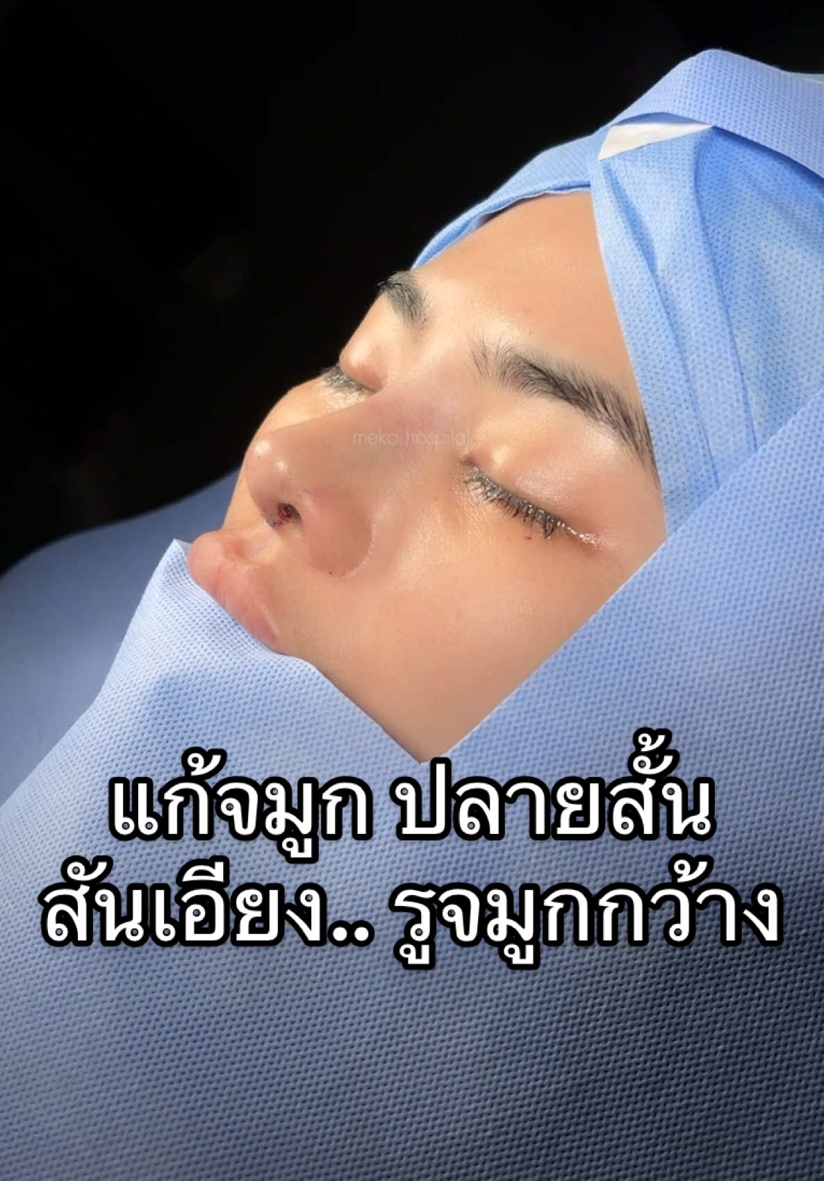 จมูกปลายสั้น รูจมูกกว้าง มีความใหญ่และหนา ทำให้ใบหน้าดูสั้น #แก้จมูก #เสริมจมูก open ปรับโครงสร้างใช้กระดูกอ่อนซี่โครง #หมอยงmekohospital #หมอยงmeko #mekohospital 