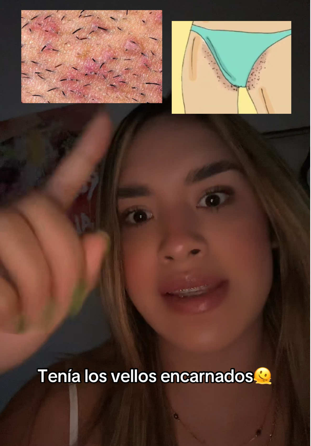 si tienes vellos encarnados, esto es para ti🚩 #vellos #vellosencarnados #mujeres #ingrownhairtreatment #razorbumps 