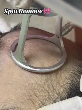 #lasertreatmentinbangladesh #csalaserena #foryouuuuu #Co2