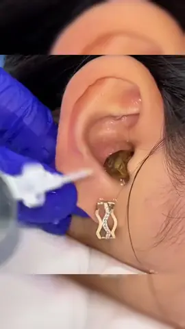 If you're not using these, START😅 ear waxremoval tool with camera earcleaning#earwax #eardrum#earwaxremovaltool#tiktokshopdeals #tiktokshopfinds#TikTokShopSpringGlowUp #dealsforyoudys