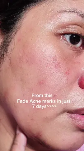 ✨Fade away acne marks with Arencia Holy Hyssop Serum 30 ✨ Formulated with 30% Holy Hyssop extract, this powerful antioxidant works to soothe irritation, reduce redness, and repair damaged skin, while 10% Niacinamide helps to brighten, even out skin tone, and minimize pores. With regular use, your skin feels hydrated, calm, and glowing with a glass-skin finish. #arencia  #holyhyssopserum  #acnemarks  #brighteningserum  #GlassSkinRoutine     @Arencia 