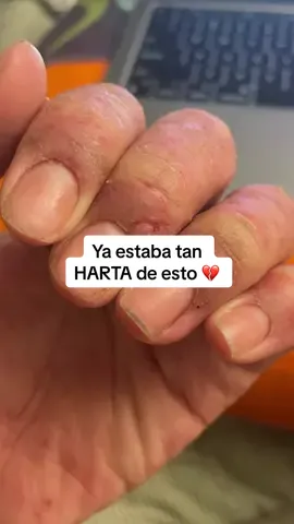 Cuando ya no confías en nadie y no sabes qué más probar, estamos aquí para tomarte de la mano y acompañarte en el camino hacia el alivio de tu dermatitis. Yo también desconfié, por eso creé Scrachee, porque todo lo que probaba empeoraba la piel y sabía que debía hacer algo para cambiar, aunque fuera un poco, las cosas 🙏🏽. Si sientes que nadie te entiende, no estás sola, estoy aquí para acompañarte a entender el eczema desde la raíz 🌱. #eczema #dermatitis