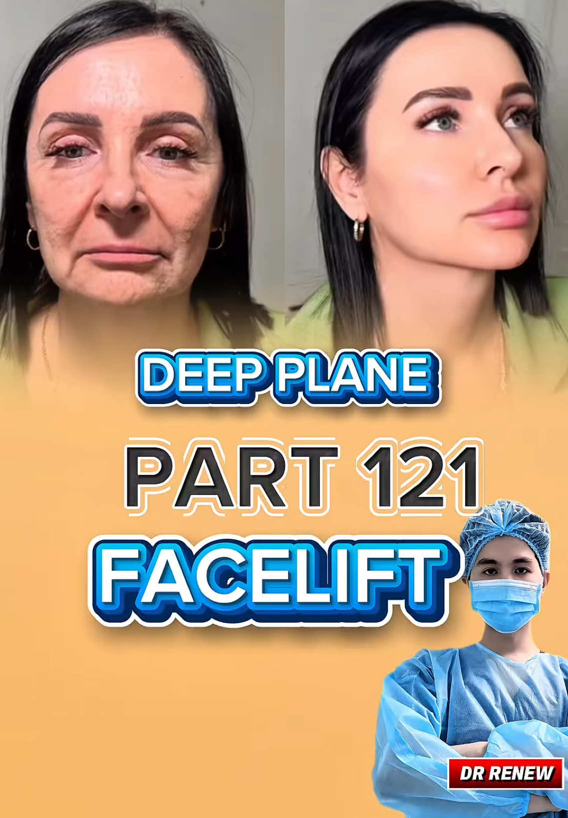 Deep Plane FaceLift DR RENEW CLINIC (Part 121)#australia #drrenew #fyp #viraltiktok #indonesia🇮🇩 