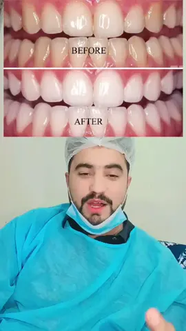 #creatorsearchinsights #teethwhitening #foryoupage❤️❤️ #plzunfrezemyaccount #support_me 