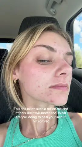 Nobody warned me about the acne in your twenties. Dark spots never go away and it’s devastating. I’m going on about 6months of this #acne #acnescars #acnetips #defeated #20something  