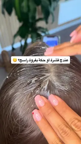 ⁨	ودّعي القشرة والحكة بهالوصفة الطبيعية السهلة 🌿✨ . . . . . . . . . . . . . . #قشرة_الشعر #علاج_القشرة #عناية_بالشعر #شعر_صحي #ماسكات_طبيعية     ⁩