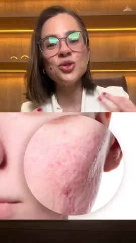 Cicatrizes de Acne - Como tratar?  #dermatologistasp #dermatoalphaville #dermatovilaolimpia #acne #acnescars 
