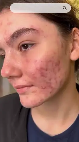 Luchando con el acné? La solución no está en taparlo, sino en sanarlo desde adentro. Con el dúo Alpha Balance + HGH de Fuxion, tu piel puede lucir más limpia, uniforme y radiante 💚 📩 Escríbeme y te cuento cómo empezar tu cambio#fuxion #productosfuxion #salud #bienestar #acnetreatment 