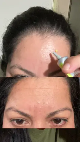 A solo días de utilizar la crema de retinal. #retinal #retinalcream #lineasdeexpresion #beauty #cremacoreana