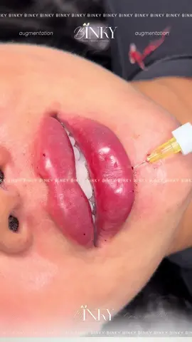 #contourlips #lips #lipstraining #russianlips #binkylips 