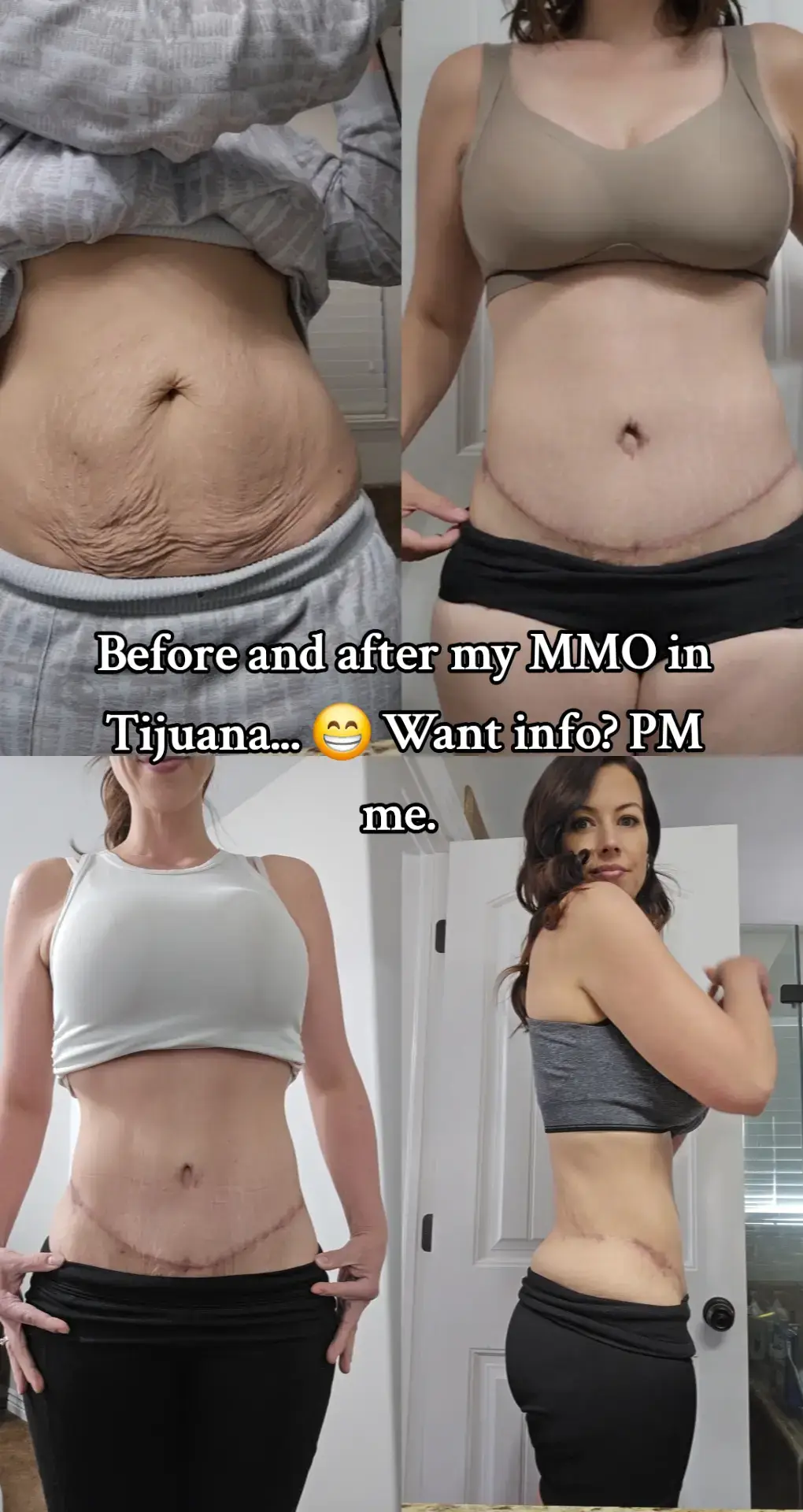 I lost 50 lbs ans wanted the extra skin gone and the ab separation fixed. I am so happy with my decision to go to Beauty and Light. Amazing results and amazing prices! pm me if you want to do the same. 😁 #MomsofTikTok #mmo #tummytuck #breastaugmentation #newfeature 