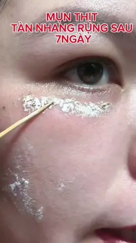 Chấm là bong cả gốc tàn nhang luôn#tinhchathutsacto #tinhchatpeelda #peelbongkhôngsưngkhôngđỏ #xuhuongpeelda