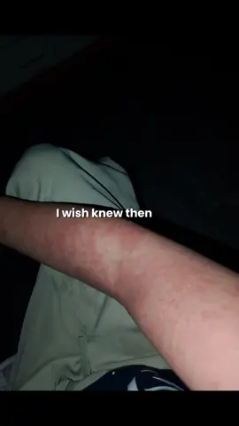 It's almost October October is Eczema Awareness Month. I had it last year October and it healed in March. It was very painful, very itchy and very stressful. I suffered for almost 6 months. I use Dermexa Aveeno and Dove Sensitive skin. For me Much better to used unsented Lotion and Mild soft🥰✨ #eczemaawareness #eczemahealing #eczemawarrior 