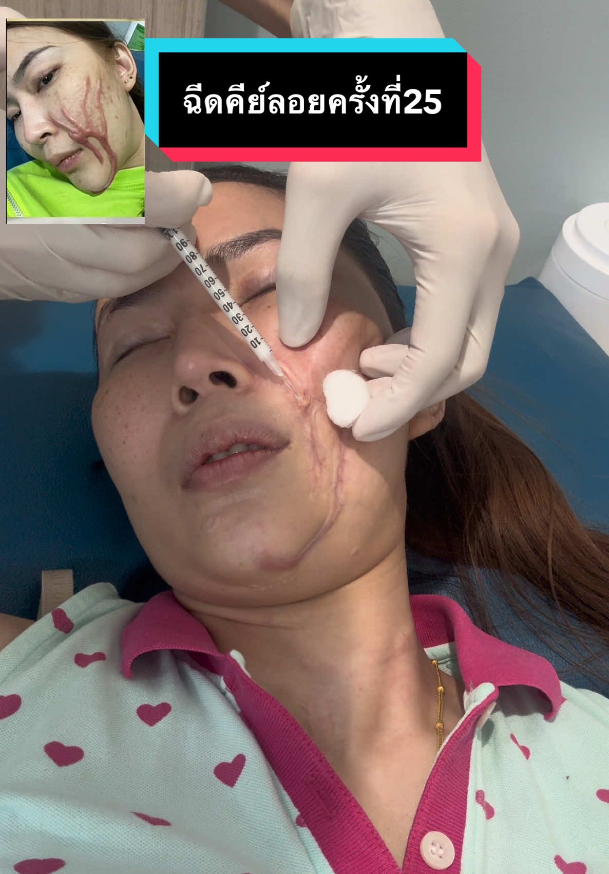 ฉีดคีย์ลอยครั้งที่25@Auiponphetสำรอง @🎀⚡AUIAYE⚡🎀 #ผิวหนังโดนโซดาไฟ #รักษาแผลเป็น #แผ่นแปะซิลิโคลนเจล #โซดาไฟถูกผิดหนัง #รักษาแผลเป็นด้วยการฉีดคีย์ลอย 