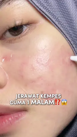 Ga perlu khawatir kalo ada jerawat, tinggal totolin aja langsung hempas deh😋🤫 #SmartAcneSpot #AcneSeriesFavBeauty #FavBeauty #reviewskincare #fyp 