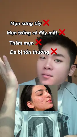 Bạn đang bị MỤN cỡ này hả ? #xuhuong #skincare 