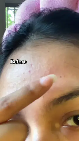 ✨ “Dark spots on my forehead? Not anymore! 🌟 Loving how Skin1004 Tone Brightening Ampoule fades hyperpigmentation and evens out my skin tone. 💛 #goviralwithskin1004challenge #skin1004white #centella #tiktokmademebuyit #kbeauty @SKIN1004 US @skin1004_influencers 