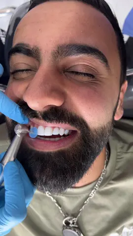 #compositeveneers #explore #explorepage #fypage #tiktoklebanon🇱🇧 