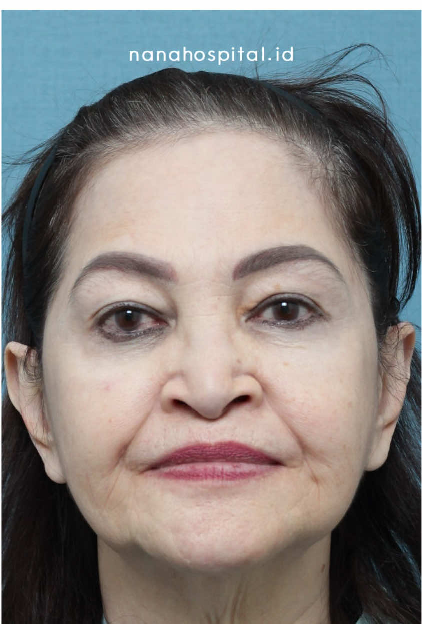 Before&After hasil operasi prosedur full face lift dan neck lift mama Nia Ramadhani  Hasil operasi anti aging mama Nia Ramadhani kali ini bagus banget kaan? Tidak merubah wajah, hanya membuat wajah terlihat lebih muda!  #antiaging #tarikwajah #awetmuda #niaramadhani #facelifting 